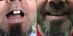 BEFORE & AFTER COMPLETE DENTURE
