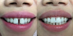 FRONT TEETH SPACE CLOSURE.FILLING