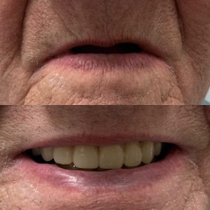 FULL DENTURE IN BUFORD, GA